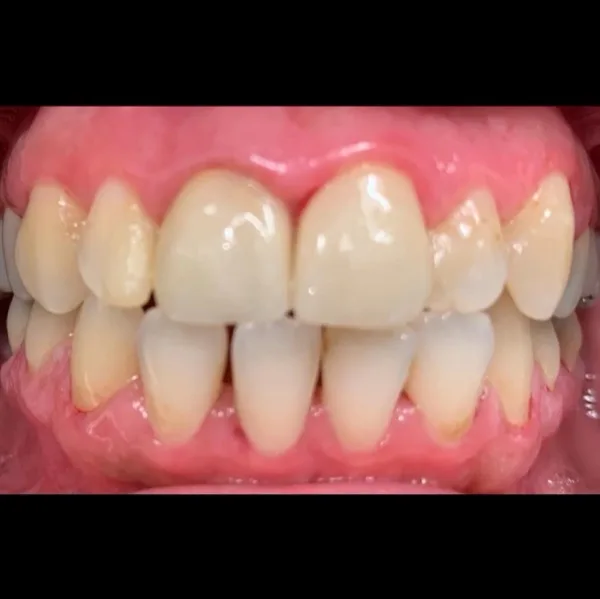 Patient smile after dental treatment, case 1
