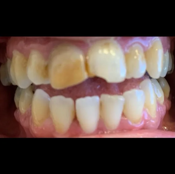 Patient smile before dental treatment, case 1