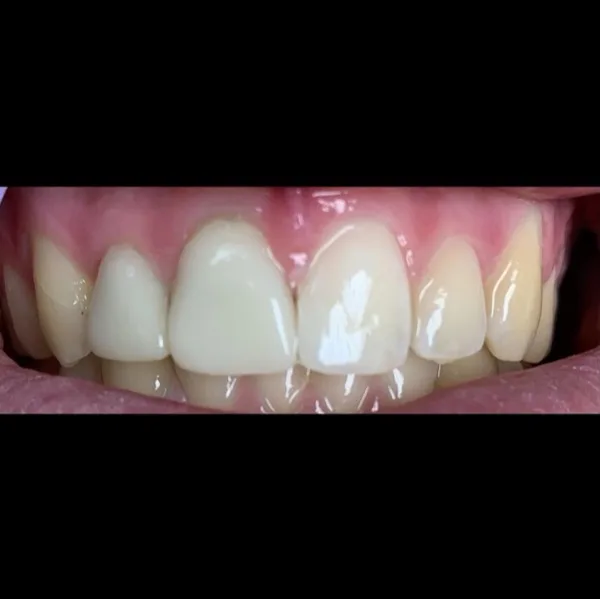 Patient smile after dental treatment, case 2