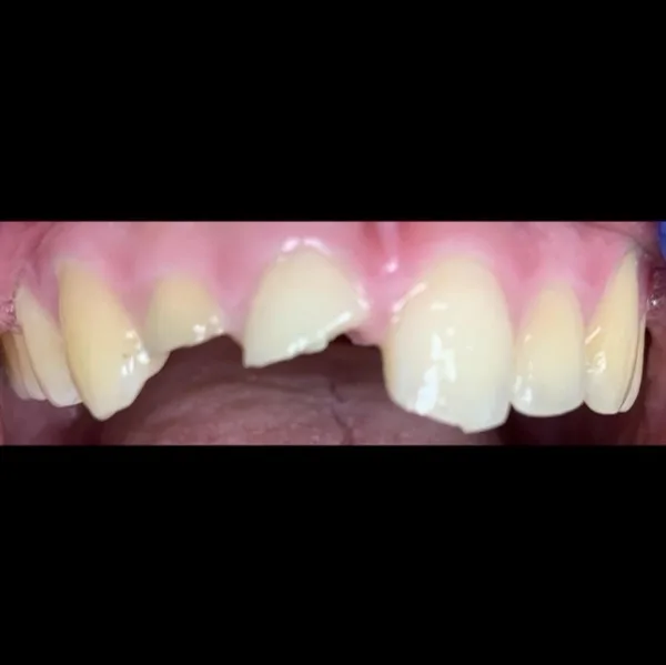 Patient smile before dental treatment, case 2