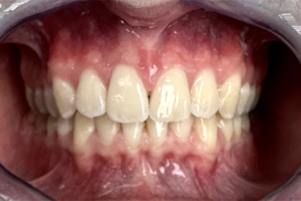 Patient smile after dental treatment, case 3