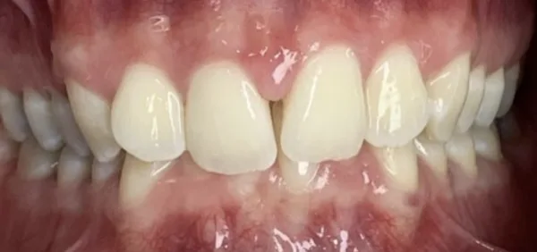 Patient smile before dental treatment, case 3