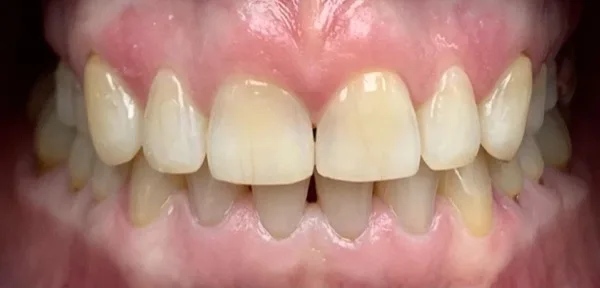 Patient smile after dental treatment, case 4