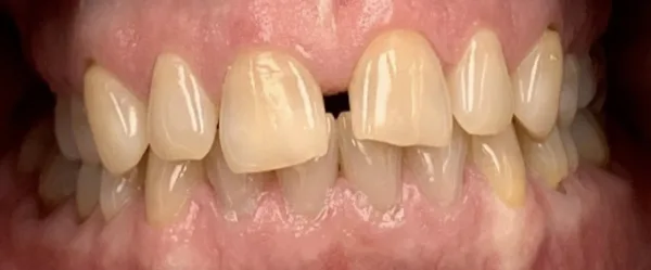 Patient smile before dental treatment, case 4