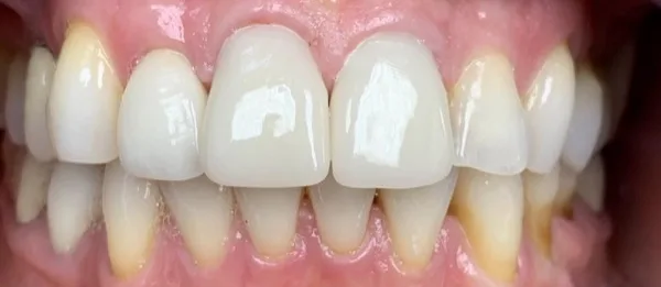 Patient smile after dental treatment, case 5