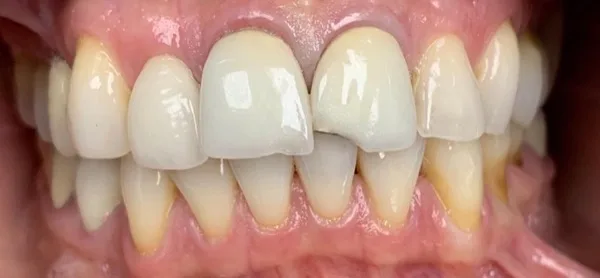 Patient smile before dental treatment, case 5