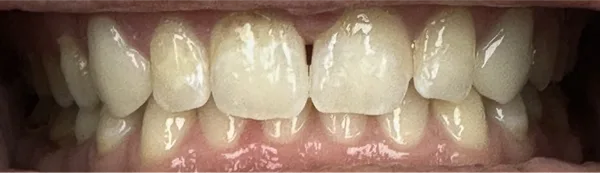 Patient smile after dental treatment, case 6