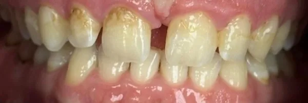 Patient smile before dental treatment, case 6